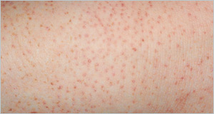 Poikiloderma Of Civatte Natural Remedy Poikiloderma Of Civatte Natural Remedy