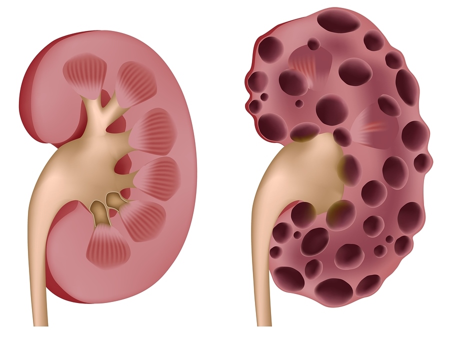 Kidney Disease Australia Pdf Ppt Case Reports Symptoms Treatment