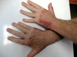 Image result for leptospirosis photos