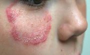 Leptospirosis