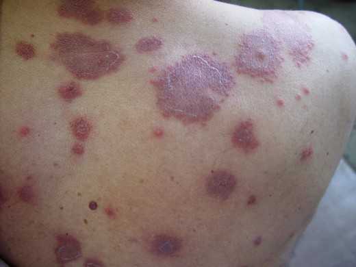 Acute lymphocytic leukemia information in philippines
