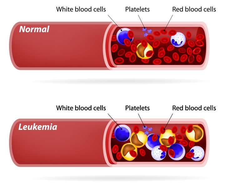 Leukemia