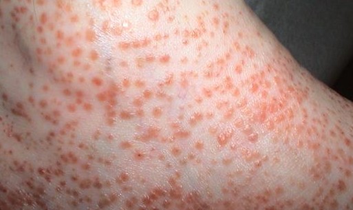 Pigmented Purpuric Dermatosis Natural Cure Pigmented Purpuric Dermatosis Natural Cure