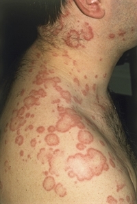 Listeriosis Mexico Pdf Ppt Case Reports Symptoms Treatment