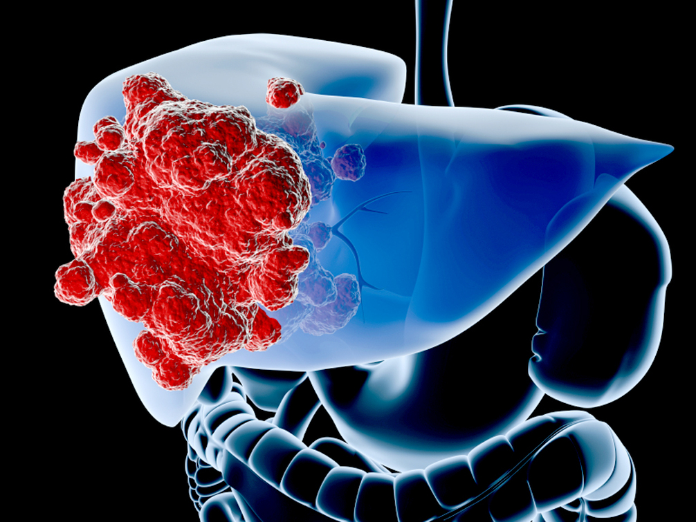 liver-cancer