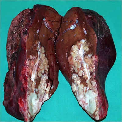 liver cancer associated selenium development cholangiocarcinoma tumors carcinoma hepatitis alcohol australia articles cirrhotic hepatocellular damaged ppts