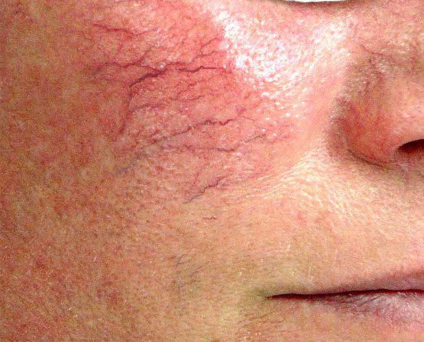 Red Blemishes On Nose Drinking Red Blemishes On Nose Drinking