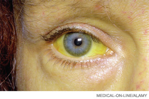 management of jaundice in adults pdf
