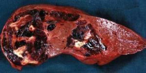Liver hemangioma