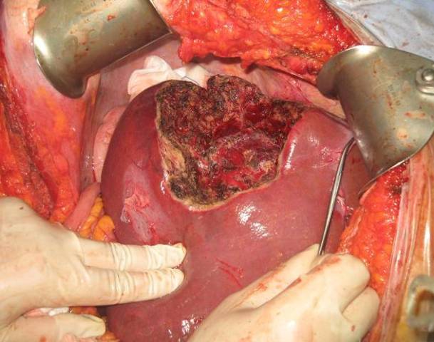 Liver Hemangioma Liver Hemangioma