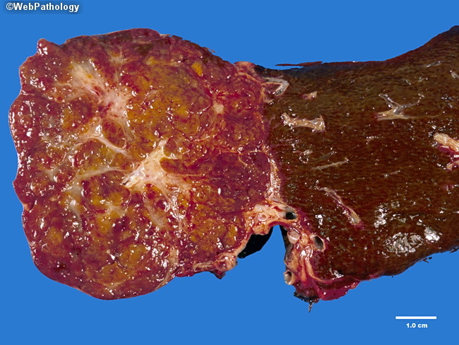 Liver Hemangioma Liver Hemangioma