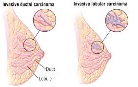 Lobular carcinoma in situ