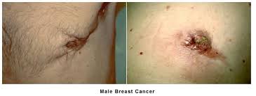 Male breast cancer