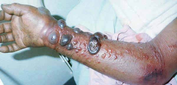 VIRUSI KUMI HATARI ZAIDI KATIKA HISTORIA YA MWANADAMU(Top ten most dangerous viruses in the world)