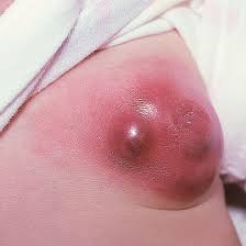 Image result for mastitis
