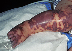 Meningococcal Disease Meningococcal Disease