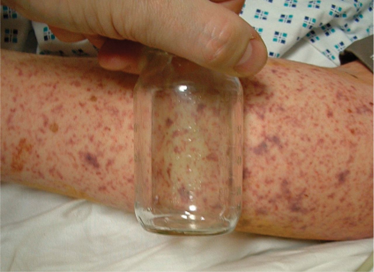 meningococcal disease Meningococcal disease is an illness caused by the bacteria neisseria meningitidis the two common presentations of meningococcal infection are meningococcal meningitis ( infection of the membranes that surround the brain and spinal cord) and meningococcemia ( infection of the bloodstream. meningococcal disease Meningococcal disease is an illness caused by the bacteria neisseria meningitidis the two common presentations of meningococcal infection are meningococcal meningitis ( infection of the membranes that surround the brain and spinal cord) and meningococcemia ( infection of the bloodstream.