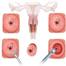 menorrhagia canada pdf ppt case reports symptoms treatment menorrhagia