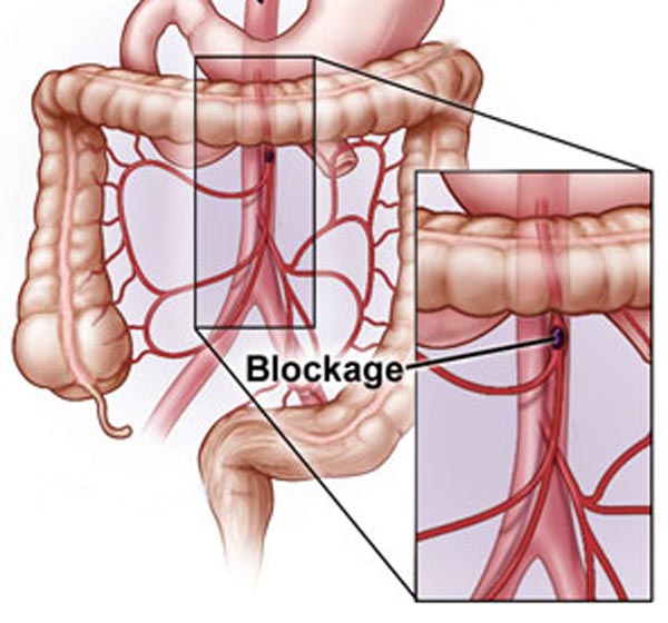 Acute Mesenteric Ischemia a Vascular Emergency