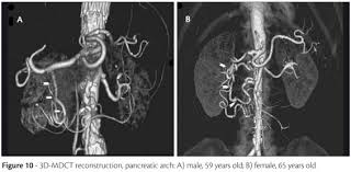 Mesenteric ischemia pdf