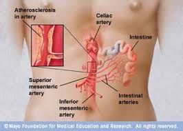 Mesenteric ischemia pdf