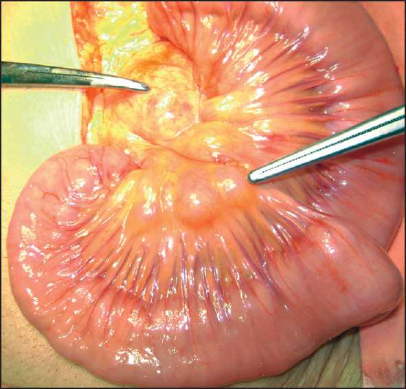 Mesenteric lymphadenitis