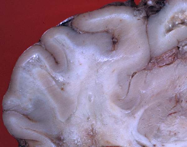 Mesenteric lymphadenitis