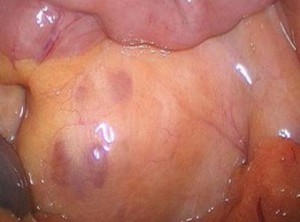 Mesenteric lymphadenitis