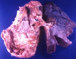 What are the most common symptoms of mesothelioma?