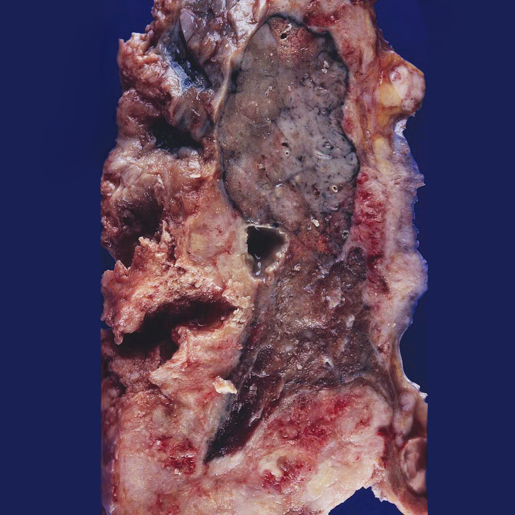 mechanisms of mesothelioma induction with asbestos and fibrous glass