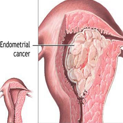 Steroids and diabetes in pregnancy