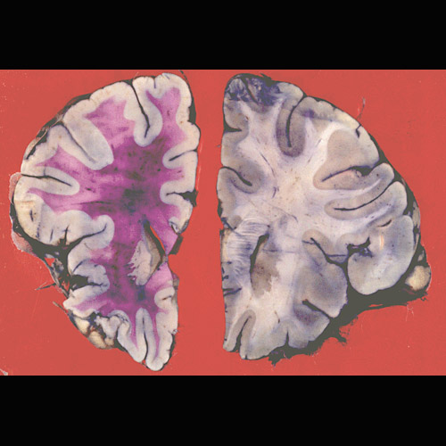 test abnormal blood u Metachromatic PDF Sweden  PPT leukodystrophy  Case