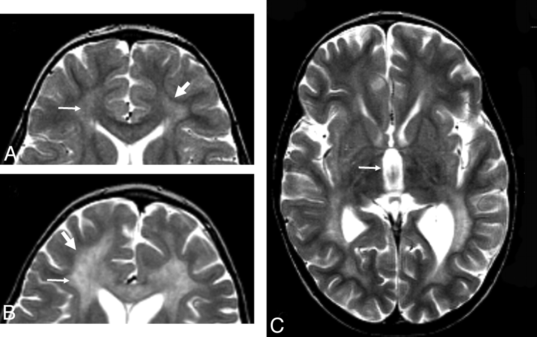 Metachromatic leukodystrophy | Ireland| PDF | PPT| Case Reports