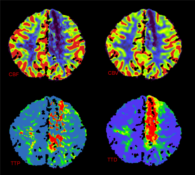 Metachromatic leukodystrophy