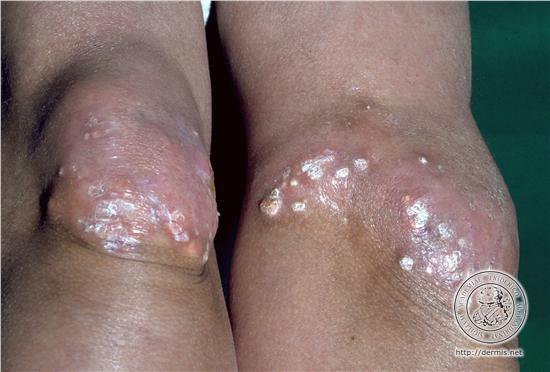 Mixed connective tissue disease