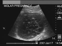 Molar pregnancy