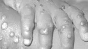 monkeypox disease symptoms singapore articles