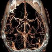 Moyamoya disease