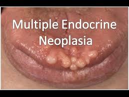 Multiple Endocrine Neoplasia(MEN-1)