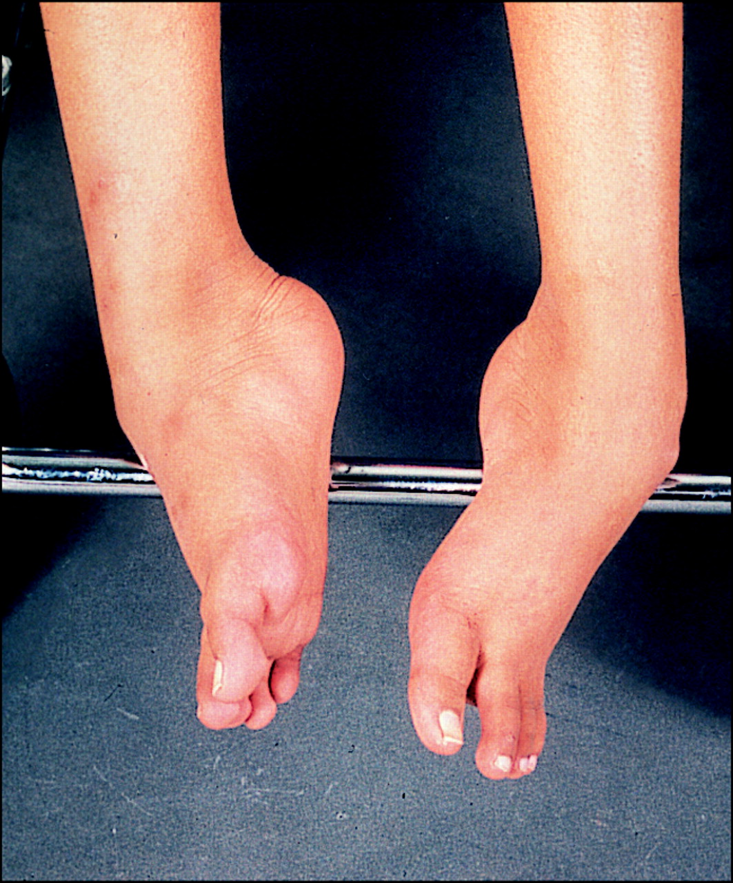 muscular dystrophy Muscular dystrophy is a term that refers to a number of diseases that cause progressive loss of muscle mass resulting in weakness and, sometimes, loss of mobility. muscular dystrophy Muscular dystrophy is a term that refers to a number of diseases that cause progressive loss of muscle mass resulting in weakness and, sometimes, loss of mobility.