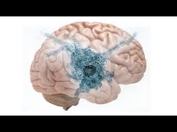 naegleria infection symptoms meningoencephalitis amoebic