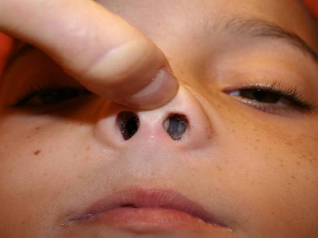 nose polyps