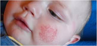 Parvovirus Infection | Spain| PDF | PPT| Case Reports | Symptoms