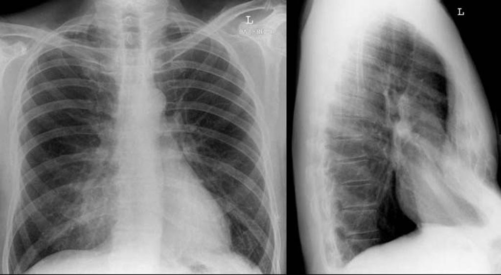 Pectus Excavatum