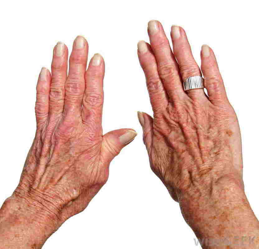 Polymyalgia rheumatica