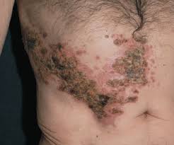 Chloroquine india