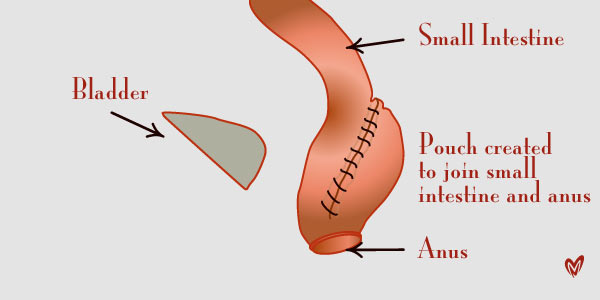 Pouchitis