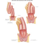 Pouchitis Natural Treatment Pouchitis Natural Treatment