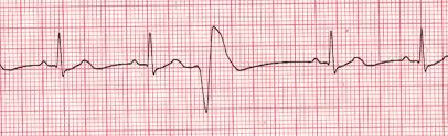 premature ventricular contractions australia pdf ppt case