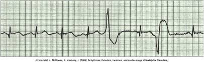 premature ventricular contractions australia pdf ppt case